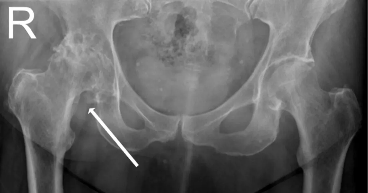嚴重的髖關節退化X光，箭頭處顯示軟骨消失