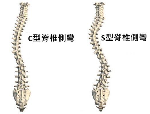 脊椎側彎類型