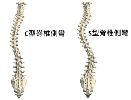 脊椎側彎類型