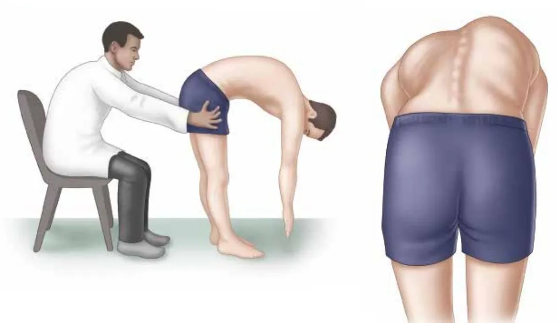 脊椎側彎亞當式前彎測試