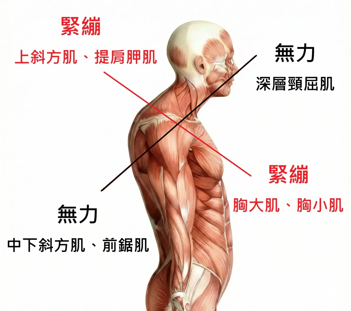 上交叉症候群成因