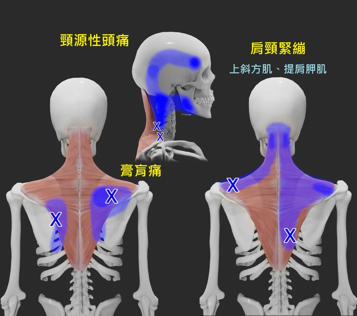 上交叉症候群疼痛特徵