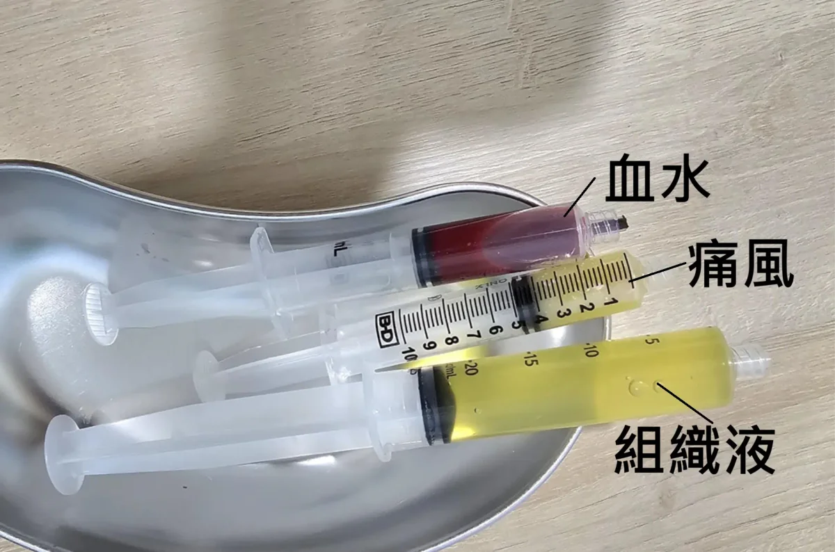 超音波導引抽積液顏色分析圖:詳細呈現淡黃發炎積液、紅色創傷出血與乳白痛風結晶液的診斷差異。