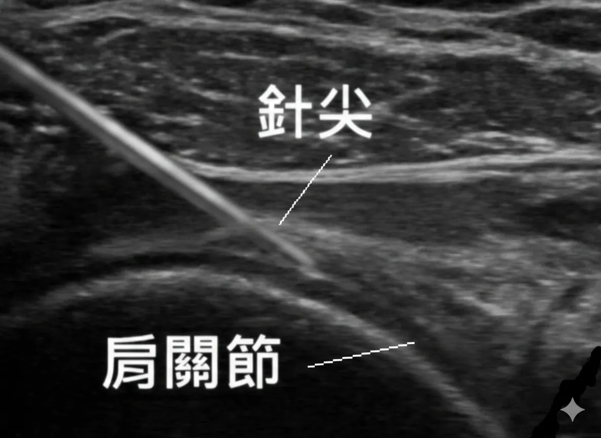 超音波導引肩關節擴張術：透過高解析影像即時定位針尖，精準撐開沾黏萎縮的肩關節囊。