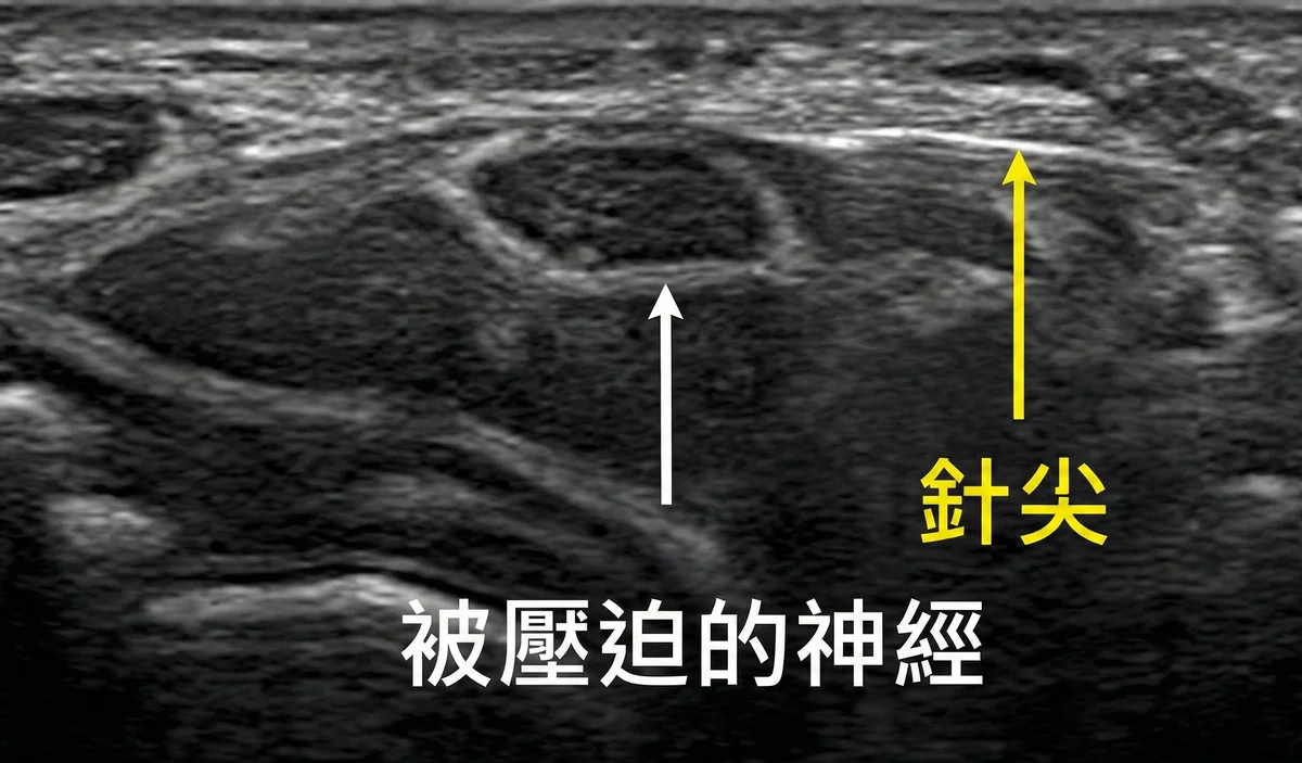 超音波導引神經解套注射圖解：精準顯示針頭如何在影像監控下進入腕隧道，並以液體壓力鬆開受壓的正中神經。